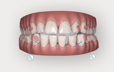 Bracetown Orthodontics -Invisalign Center
