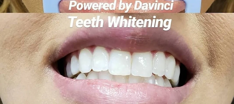 DaVinci Laser Teeth Whitening of Northern CO