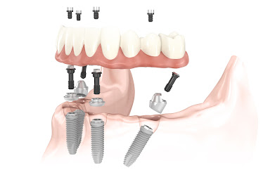 Georgia Implants and Dentures