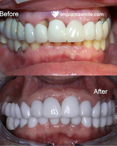 implantasmile.com