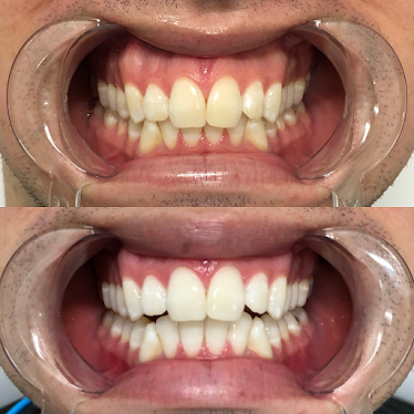 Minte Teeth Whitening