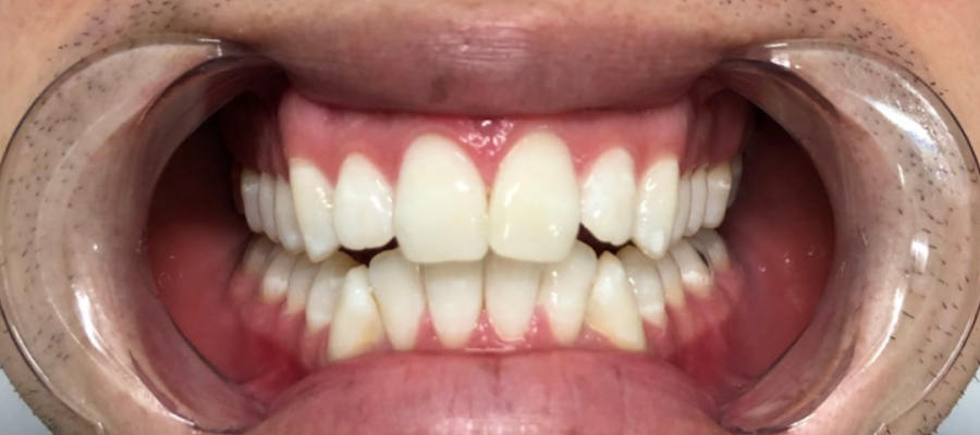 Minte Teeth Whitening