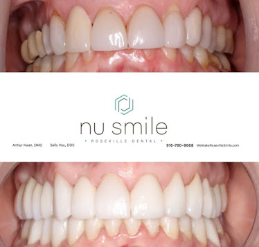 Nu Smile Roseville California • Cosmetic Dentist • Implant • TMJ dentist • Invisalign Clear Braces