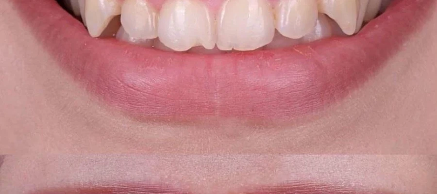 NÜVA Smile