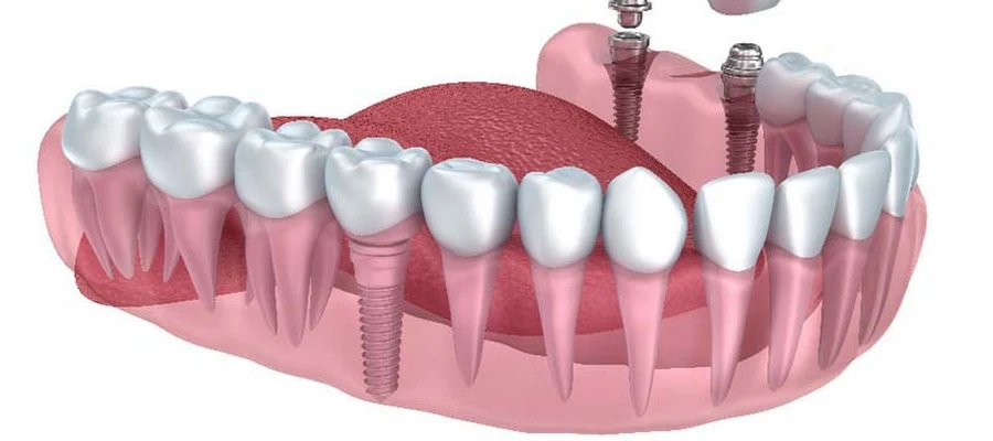 PearlFection Dentistry