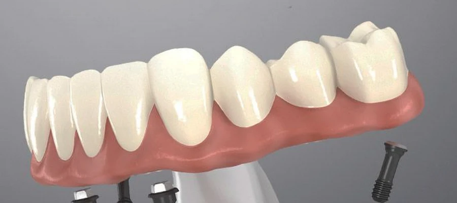 Smile For Success Dental Center - Tim Do Nha Khoa Lab Denture, Implant & Crown