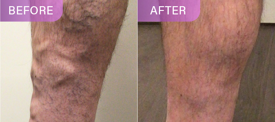 Vein Treatment Clinic
