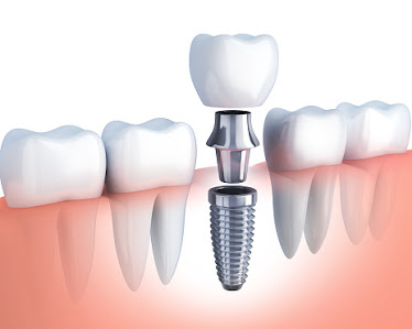Whitlow Dental Care - Dental Implant Center