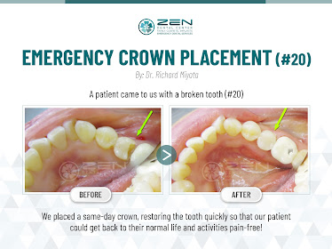 Zen Dental Center Family Cosmetic Emergency Implants